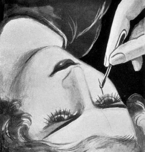 1946 Applying single lashes (Verni, 1946).