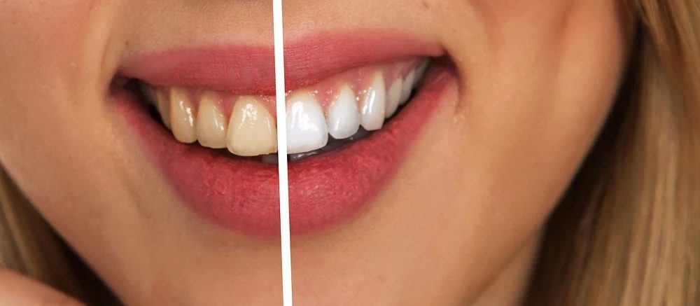 Tooth whitening - before and after
