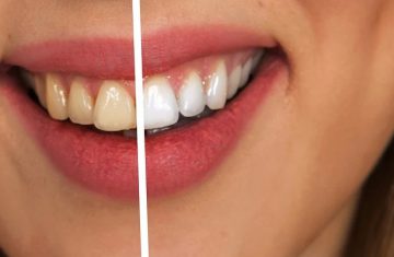 Tooth whitening - before and after