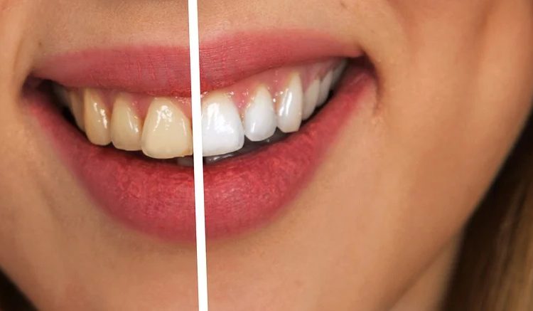 Tooth whitening - before and after